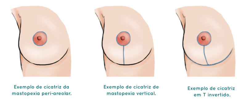Mastopexiao