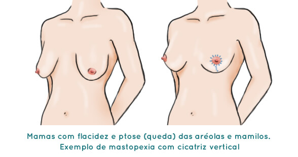 Mastopexia