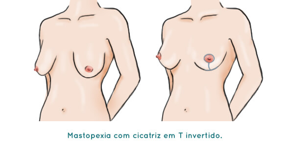 Mastopexia